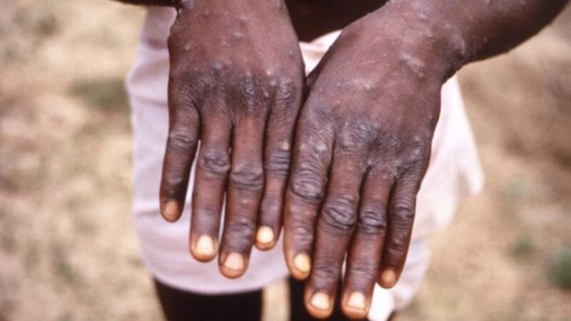 OMS avalia nova emergência sanitária devido ao surto de Mpox na África